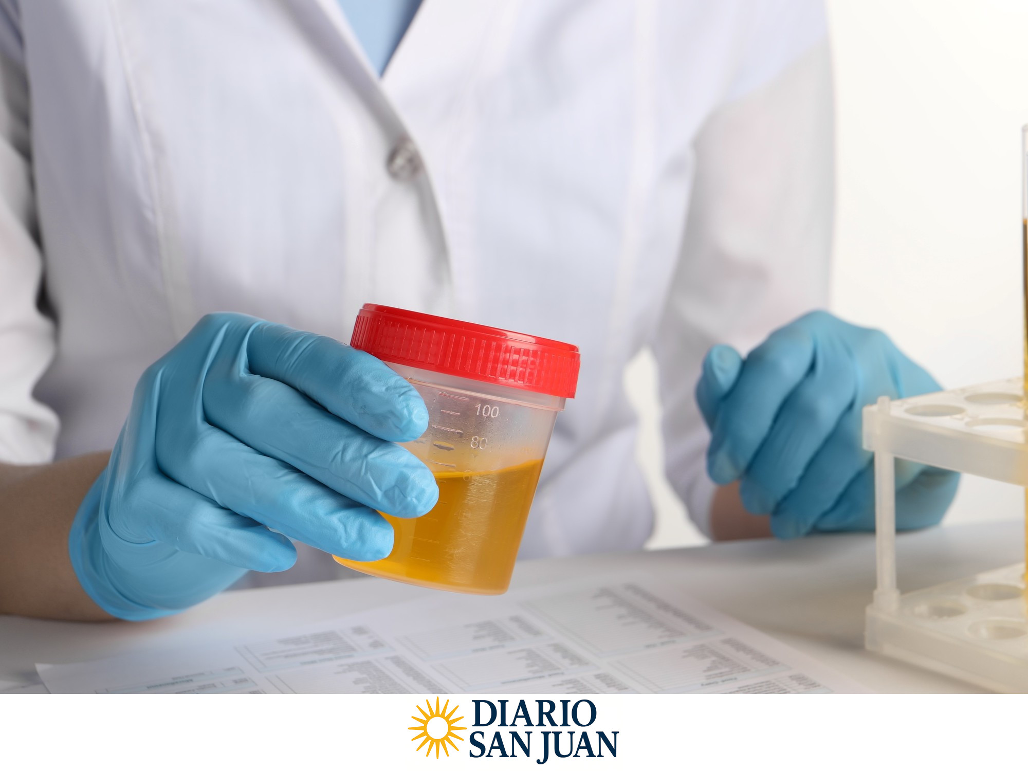 Las infecciones de las vías urinarias y los cálculos renales pueden hacer que la orina se vea turbia u opaca. Foto: Shutterstock.